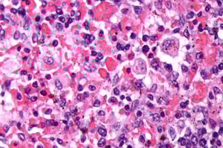 Picture of hemophagocytic lymphohistiocytosis