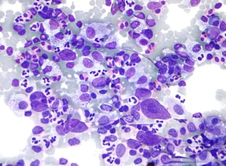 Picture of Hodgkin lymphoma