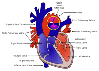 Picture of patent ductus arteriosus