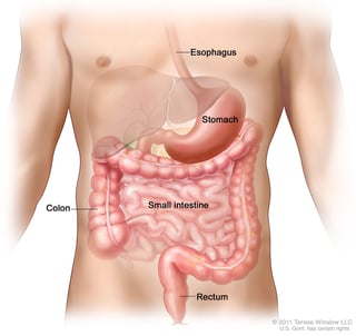 Picture of gastrointestinal stromal tumor