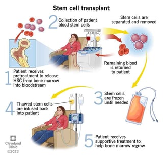 Picture of Hematopoietic stem cell transplantation