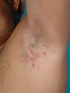Picture of hidradenitis suppurativa