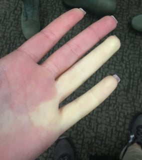 Picture of Raynaud disease