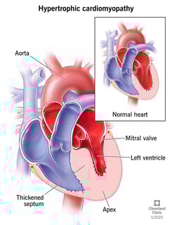 Picture of Hypertrophic cardiomyopathy