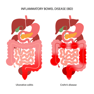Picture of Inflammatory bowel disease