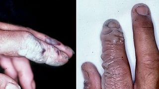 Picture of chemical burn
