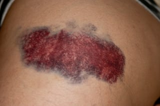 Picture of bruise