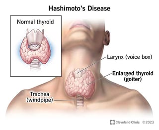 Picture of Hashimoto's thyroiditis