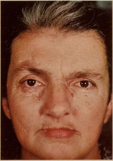 Picture of basal-cell carcinoma