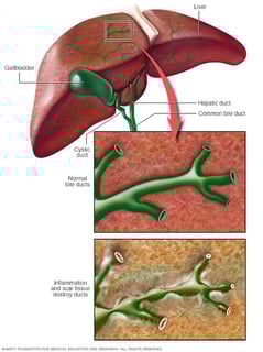 Picture of primary biliary cirrhosis