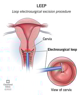 Picture of Loop electrical excision procedure