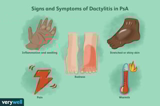 Picture of Dactylitis