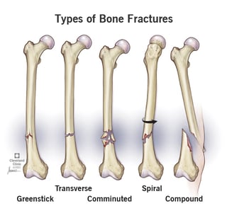 Picture of bone fracture