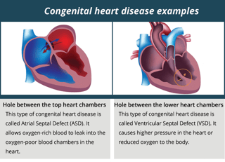 Picture of Congenital heart defect