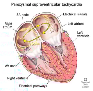 Picture of supraventricular tachycardia