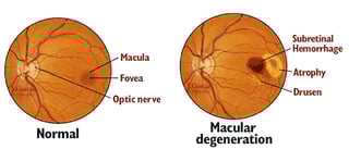 Picture of age related macular degeneration