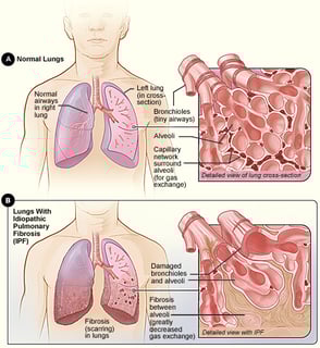 Picture of fibrosis