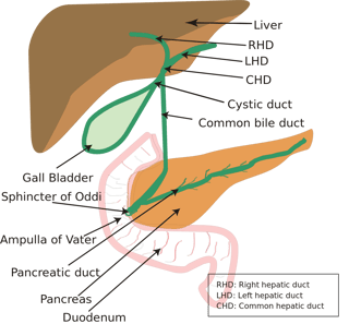 Picture of Periampullary cancer