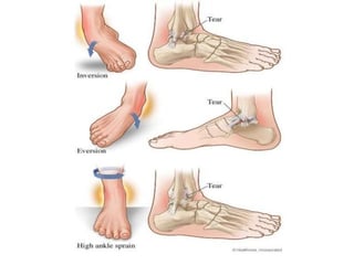 Picture of High ankle sprain