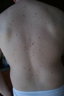 Picture of Nevus
