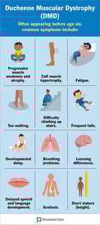 Picture of Duchenne muscular dystrophy