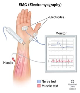 Picture of Electromyography