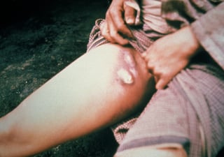 Picture of bubonic plague