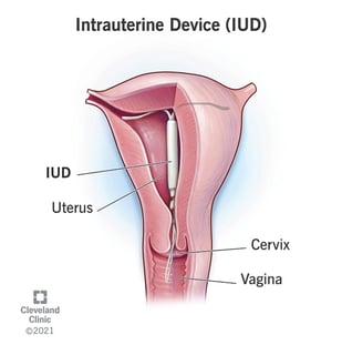Picture of Intrauterine device