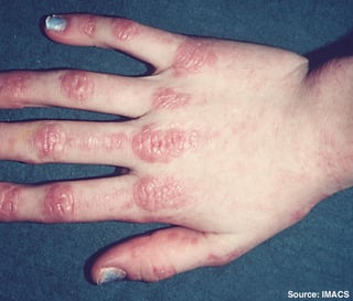 Picture of dermatomyositis