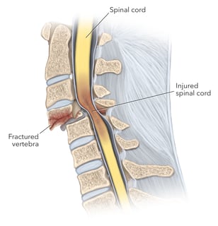 Picture of spinal cord injury
