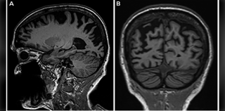 Picture of Posterior cortical atrophy