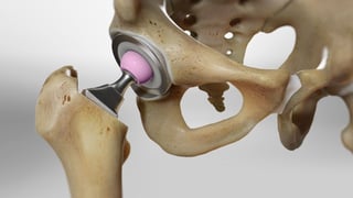 Picture of Hip replacement