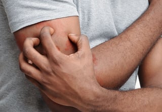Picture of itch