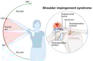 Picture of shoulder impingement syndrome