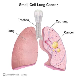Picture of lung cancer