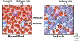 Picture of leukemia