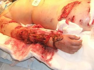 Picture of animal bite