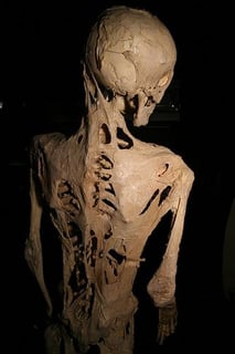 Picture of fibrodysplasia ossificans progressiva