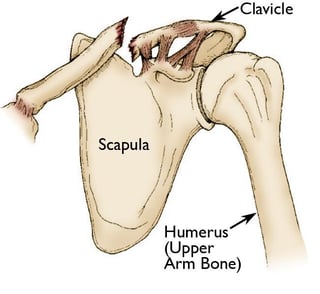 Picture of clavicle fracture