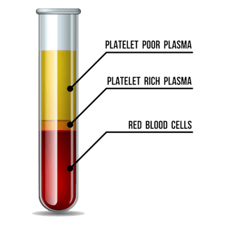 Picture of Platelet-rich plasma