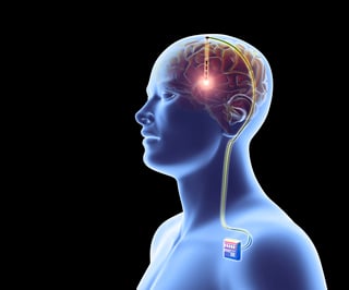 Picture of Brain implant