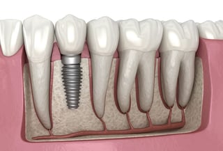 Picture of Implant