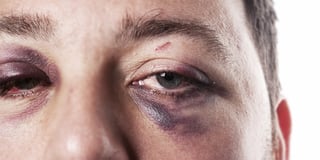 Picture of black eye