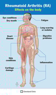 Picture of rheumatoid arthritis