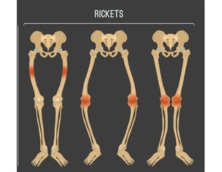 Picture of rickets