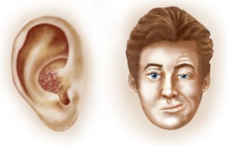 Picture of geniculate herpes zoster