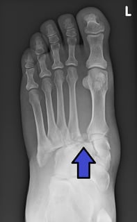 Picture of Lisfranc injury