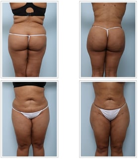 Picture of Buttock augmentation
