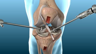 Picture of Anterior cruciate ligament reconstruction