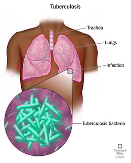 Picture of tuberculosis